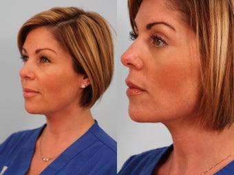 Lower blepharoplasty before 249304