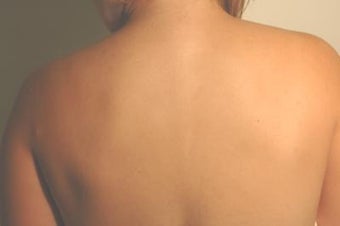 Laser Back Acne Treatment after 82961