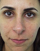 Hydrelle Injection For Treating Laugh Lines or Nasolabial Folds before 196049