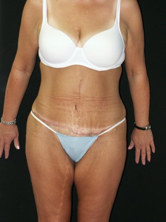 Body Lift after 379789