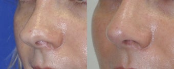 Revision Rhinoplasty before 548881