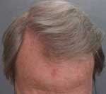 Hair Transplant after 426682