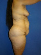 Breast Lift with Implants, Extended Tummy Tuck, 399479