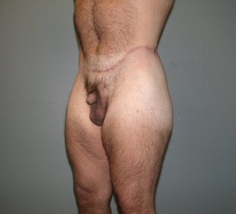 Lower body lift after 282598