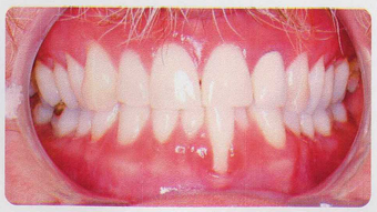 Low incisor extraction before 353445