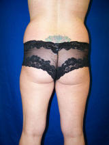 Liposuction of the flanks and medial thighs before 130054