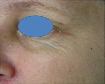 TCA Chemical Peel before 76521