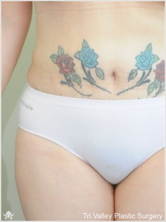 Liposuction after 420936