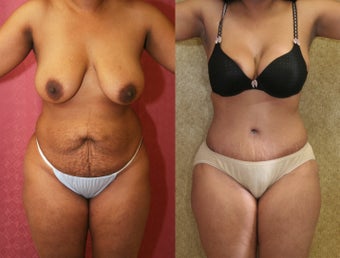 tummy tuck before 304701