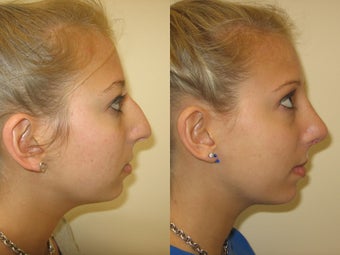 Rhinoplasty before 223020
