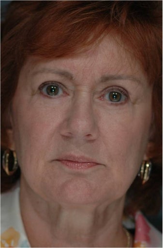 Upper and Lower Blepharoplasty or Eyelid Lift, Eye Bags treatment after 292969