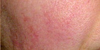 Photofacial after 272077