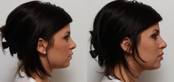 Non Surgical Nose Job Rhinoplasty before 553496