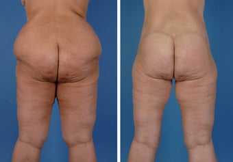 Lower Body Lift and Thighplasty 335986