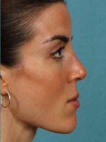 Revision Rhinoplasty 581089