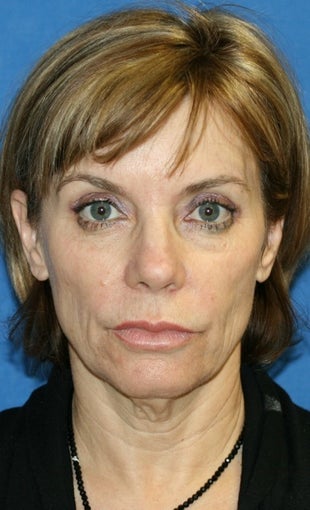 Facelift with Extended Necklift, Lateral Browlift, Fat Transfer, and Skin Pinch before 540338