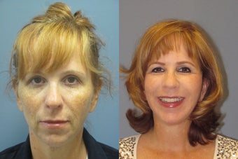 Lite Lift, Chin augmentation, liposuction of the neck before 523354