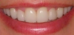 Botox for a gummy smile 371663