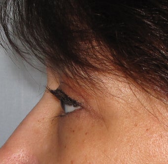 Upper Blepharoplasty after 125924