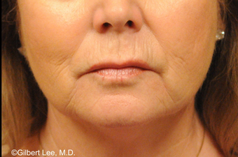 Upper lip shortening before 451906