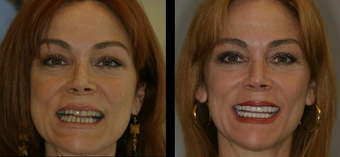 Smile Makeover With Veneers Photo From Jennifer Jablow, DDS, New York ...