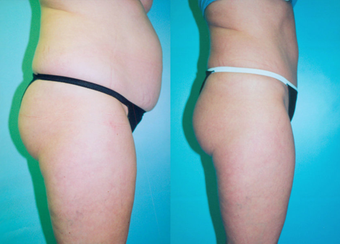 Tummy Tuck before 263629