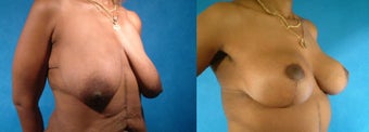 Breast and Body Lift before 134070