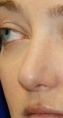 Rhinoplasty 390972