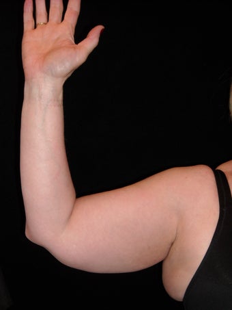 Liposuction of upper arm before 237752