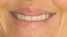 Lip Surgery, Lip Reduction before 458985