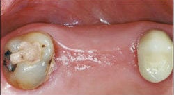 Dental Implants For Missing Back Teeth before 504350