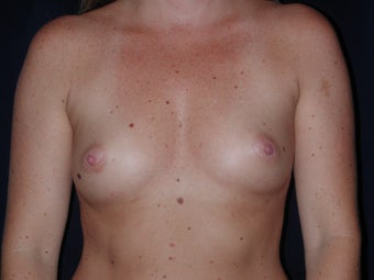 Breast Augmentation before 336407