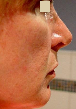 Radiesse Cheek Lift before 152204