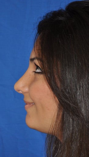 Rhinoplasty 373759