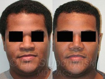 African American Rhinoplasty before 374018