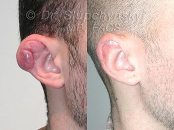 Keloid Removal before 615714