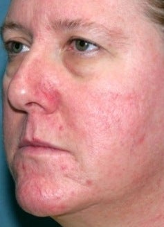 PDL for rosacea before 374579