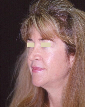 Facelift / Necklift before 103849