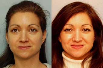 Sculptra treatment for cheeks before 125899