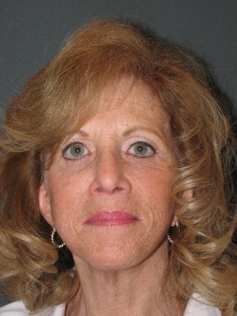 Facelift and Chemical Peel after 123603