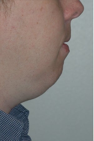 Chin augmentation, neck liposuction, and neck muscle tightening before 277313