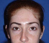 Otoplasty (Ear) Surgery after 123020