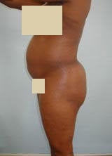 Body Contouring with Liposuction before 133795