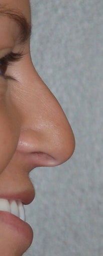 Rhinoplasty - Hump Reduction, Lift Drooping Tip before 134439
