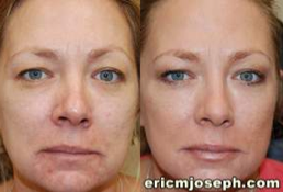 Non-Surgical Facial Rejuvenation with BOTOX Cosmetic and Silikon-1000 before 130990