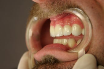 porcelain bridge with veneers replacing teeth after 466255