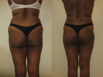 Gluteal augmentation after 220822