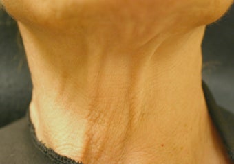 Botox before 410999