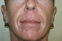 Radiesse and Juvederm XC before 281819
