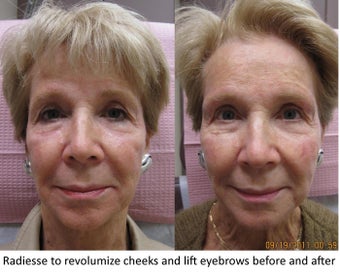 Radiesse facial rejuvenation - Revolumization of Cheeks and Eyebrow Lift before 390172